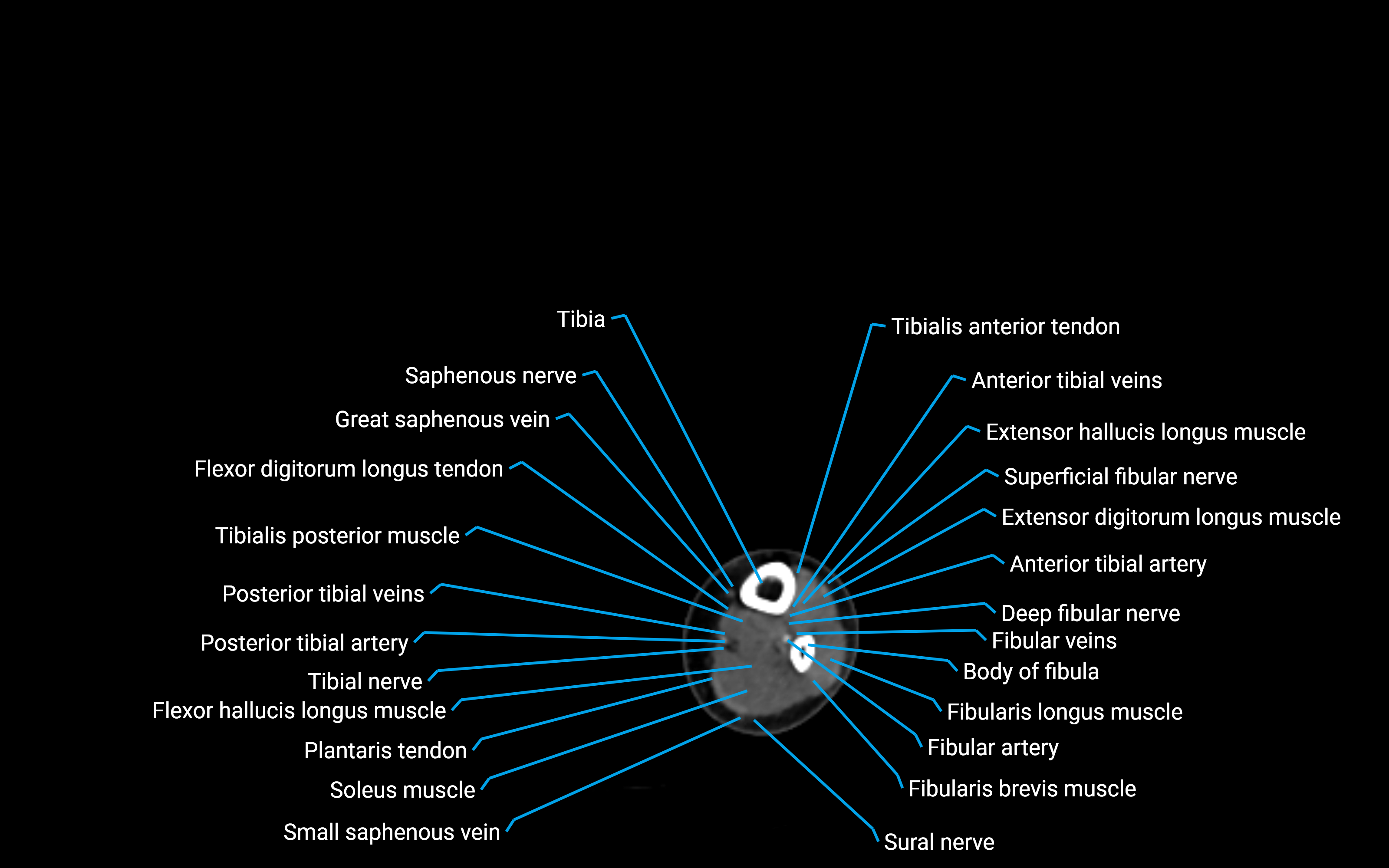 CT Lower leg axial cross sectional anatomy labelled image 147 (2).png